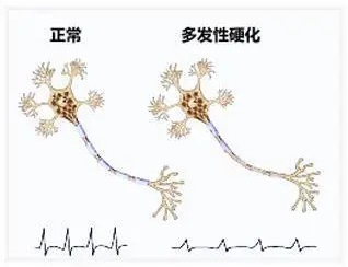 那他珠单抗治疗多发性硬化症残疾持续增加率仅为17%！(图1)